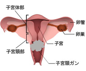 子宮頸ガンについての説明図
