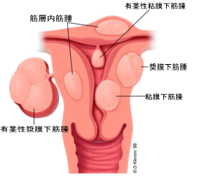 子宮筋腫の画像