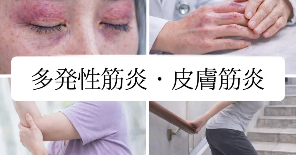 【膠原病】多発性筋炎・皮膚筋炎の特徴と中医学な対処法
